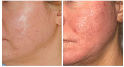 Contra ctube x 120g Gel   For Burns Tattoo Surgery Scars   German Brand   English Leaflet