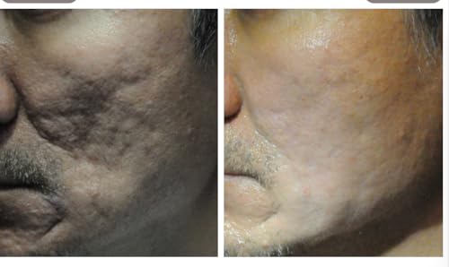 Contra ctube x 120g Gel   For Burns Tattoo Surgery Scars   German Brand   English Leaflet