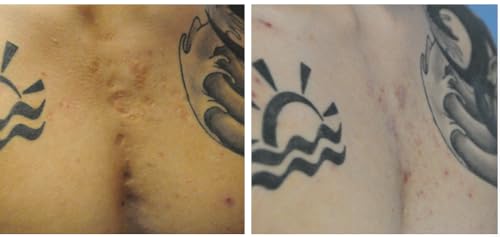 Contra ctube x 120g Gel   For Burns Tattoo Surgery Scars   German Brand   English Leaflet