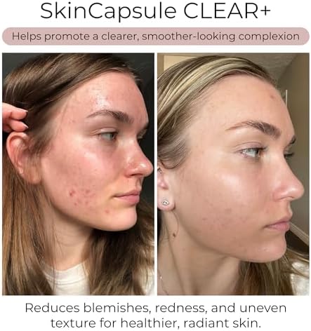 Hush & Hush Acne Supplements for Clear Skin   Clinically Proven Formula to Reduce Breakouts & Blemishes   Supports Hormonal Balance with Vitamin A  Zinc & Antioxidants   Vegan  Non GMO   60 Capsules