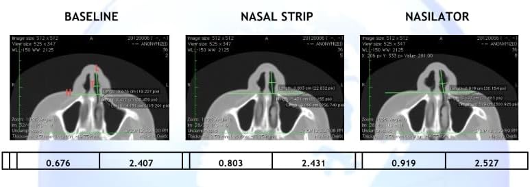 Made in USA  Nasilator Anti Snoring Devices   Soft and Flexible Nasal Dilators   Improves Breathing & Sleeping   Snoring Solution   Reusable & Better Than Nasal Strips Pack of 4  Medium 