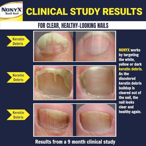 NONYX Fungal Nail Clarifying Gel   Clinically Proven for Discolored  Thick  Brittle  Yellow  Lifted  and other signs of Fungus Damaged Toenails   90  of Nails Improve   Over 8 million sold