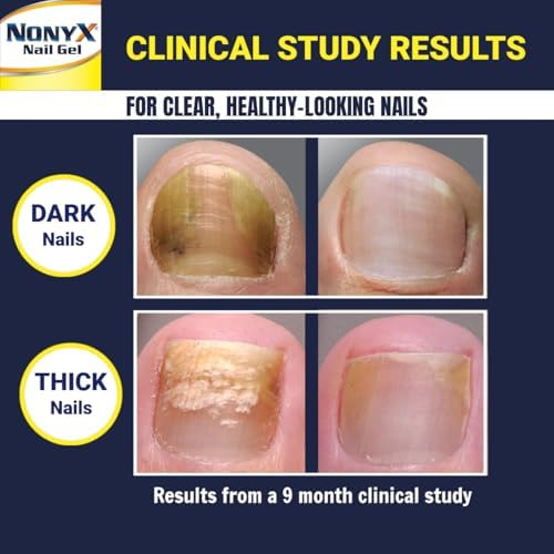NONYX Fungal Nail Clarifying Gel   Clinically Proven for Discolored  Thick  Brittle  Yellow  Lifted  and other signs of Fungus Damaged Toenails   90  of Nails Improve   Over 8 million sold