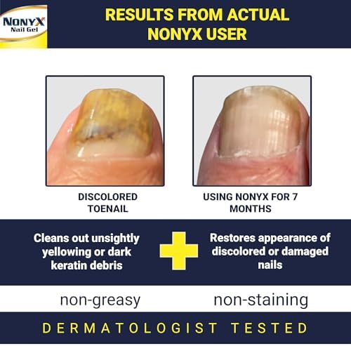 NONYX Fungal Nail Clarifying Gel   Clinically Proven for Discolored  Thick  Brittle  Yellow  Lifted  and other signs of Fungus Damaged Toenails   90  of Nails Improve   Over 8 million sold
