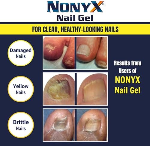 NONYX Fungal Nail Clarifying Gel   Clinically Proven for Discolored  Thick  Brittle  Yellow  Lifted  and other signs of Fungus Damaged Toenails   90  of Nails Improve   Over 8 million sold