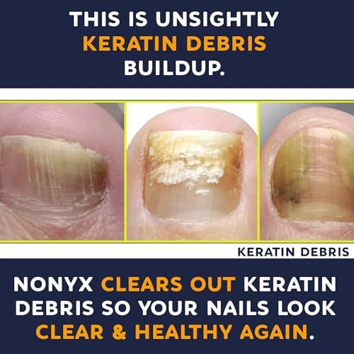 NONYX Fungal Nail Clarifying Gel   Clinically Proven for Discolored  Thick  Brittle  Yellow  Lifted  and other signs of Fungus Damaged Toenails   90  of Nails Improve   Over 8 million sold
