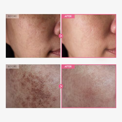 TOSOWOONG Arbutina 7% + Ácido Tranexámico 4% Crema, 70,000ppm Arbutina, 40,000ppm TXA, Niacinamida, Glutatión, Manchas Oscuras, Pecas, Imperfecciones, Pigmentación, Cuidado de la Piel Coreana, 50ml