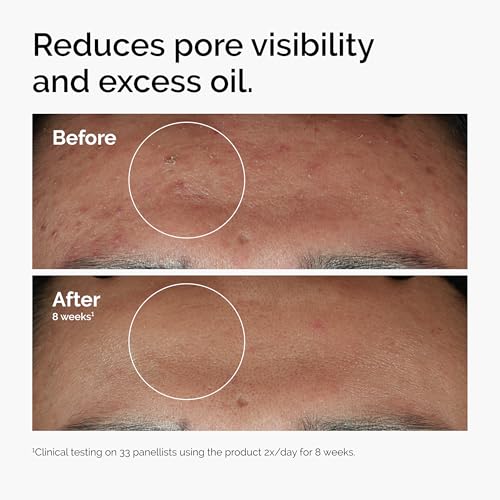 The Ordinary Niacinamide 10    Zinc 1   Smoothing Serum for Blemish Prone Skin